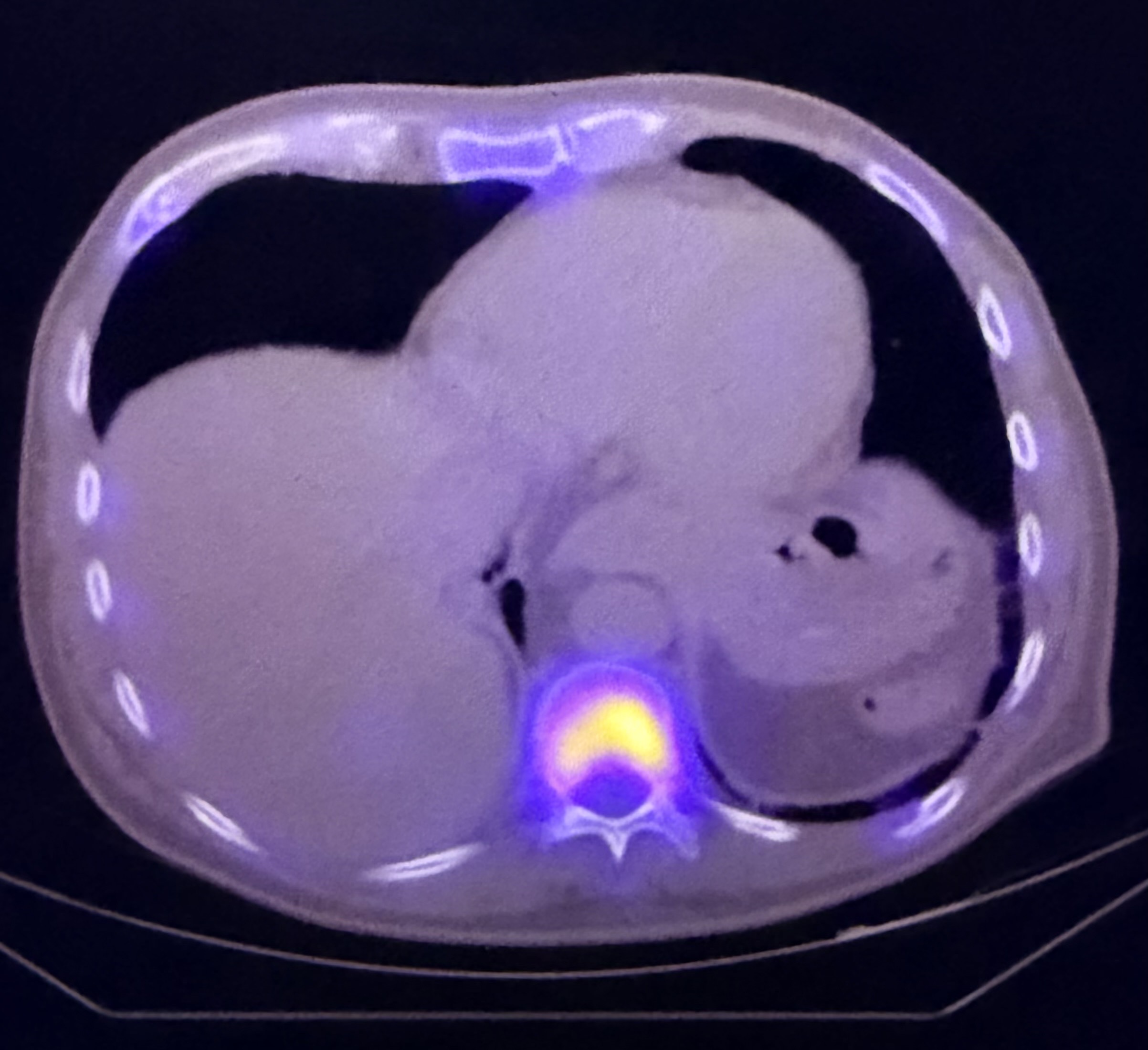 PET/CT example used to illustrate myeloma bone and metastatic assessment